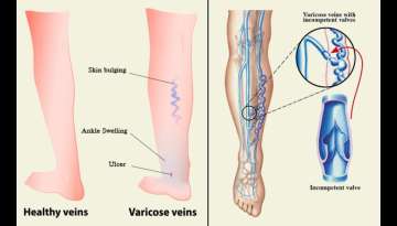 Natural Remedy Options for Varicose Vein